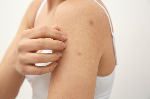 Immagine di un primo piano della spalla di una donna con cannottiera bianca e una mano davanti intenta a toccare la pelle acneica, simbolo dell’articolo del blog dedicato ai panel fragili, come rendere il testing cosmetico efficace e inclusivo, della business unit cosmetic & medical device di Lifeanalytics